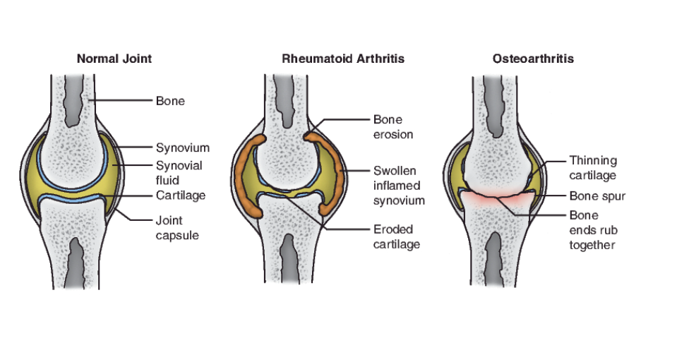 <ul><li><p><span><strong>Osteoarthritis (OA) or degenerative joint disease (DJD)</strong></span></p><ul><li><p><span>Articular cartilage wears away</span></p><p></p></li></ul></li><li><p><span><strong>Rheumatoid arthritis</strong></span></p><ul><li><p><span>Systemic, autoimmune</span></p></li><li><p><span>Also affects eyes &amp; internal organs</span></p></li><li><p><span>Exacerbation/ remission</span></p></li></ul></li></ul><p></p>