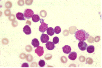 <p>The predominant cell seen in this CSF are from a twelve-year old female exhibiting fever, lethargy, and a stiff neck. The WBC count on the sample was 2000/microliter. The findings most likely indicate:</p><p>Normal cytocentrifuged smear</p><p>Viral meningitis</p><p>Bacterial meningitis</p><p>Alzheimer’s disease</p>