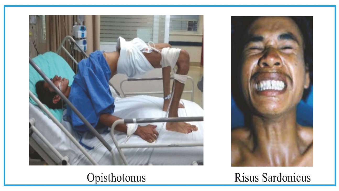 <p>Risus Sardonicus (looks like patient is smiling but it's muscle contraction)</p><p>Opisthotonos</p><p></p>