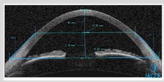 <ul><li><p>Eye’s total sagittal height = sag @ 10 mm + sag @ 15 mm</p><ul><li><p>Example: 2100 μm + 1900 μm = 4000 μm</p></li></ul></li><li><p>Initial diagnostic CL = 4000 μm sagittal height + 300 μm apical clearance = 4300 μm</p></li></ul><p></p>