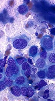 <ul><li><p><span style="color: red"><strong>Benign:</strong></span><strong> <u>papilloma, adenoma</u></strong></p></li><li><p><span style="color: red"><strong>Malignant:</strong></span> carcinoma, adenocarcinoma</p></li><li><p>Cells in <strong><u>clusters</u></strong>/clumps/acini</p></li><li><p><strong><u>Round</u> </strong>nuclei with <strong>moderate cytoplasm</strong></p></li><li><p><strong><u>Exfoliate well</u></strong></p></li></ul><p></p>
