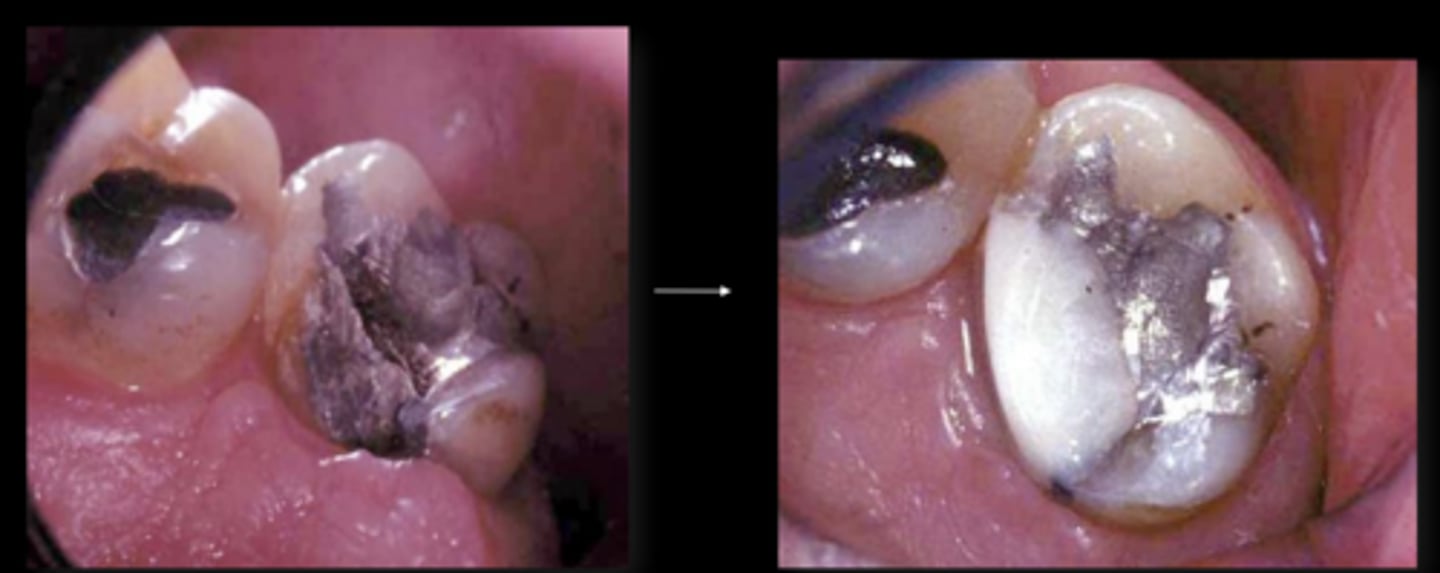 <p>As a placeholder until the patient can come back for the final restorations</p>