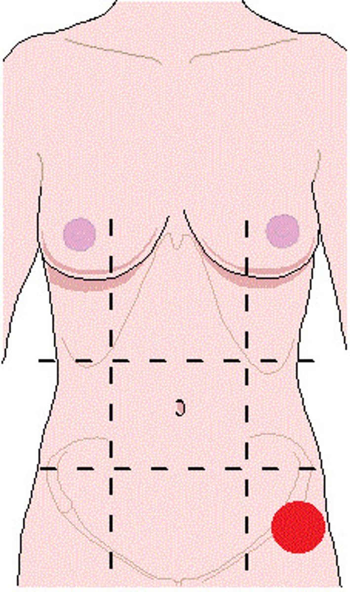 <p>Location:</p><p>Abdominal wall (anterior)</p><p>Description:</p><p>One of nine regions of abdominal cavity</p><p>Left lower lateral region</p><p>Contents include parts of small and large intestines</p>