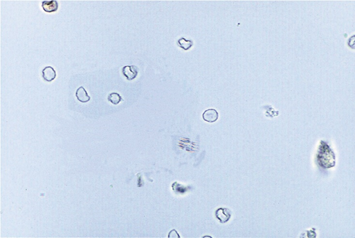 <p>what can cause dysmorphic RBCs?</p>
