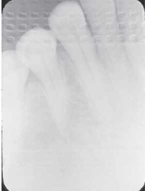 <p>How would you resolve this Reversed/Backward Placement X-ray?</p>