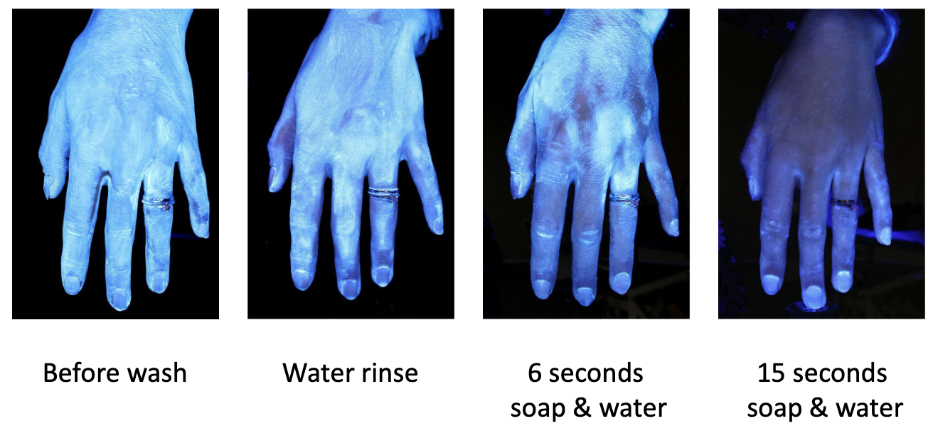 <ul><li><p>Soap disrupts adhesion externally</p></li><li><p>Not usable internally in urinary tract</p></li><li><p>Need safer, targeted alternatives</p></li></ul><p></p>