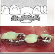 <p>1st designed, the wing like retainers which contain conical perforations for retention </p>