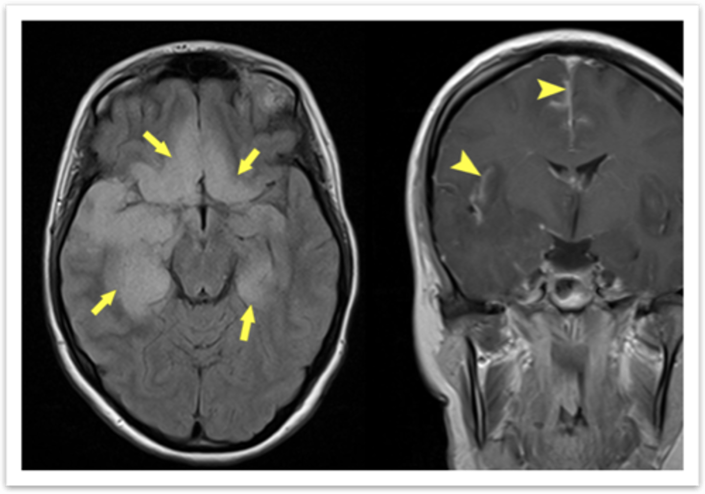 <p>In Viral Encephalitis, the MRI WWOC shows what?</p>