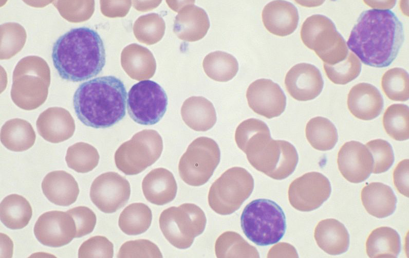<ul><li><p>increased number of mature B lymphocytes </p></li><li><p>normal WBC range is 4-10k, patients with leukemia can have WBC counts &gt; 100 k </p></li></ul><p></p>