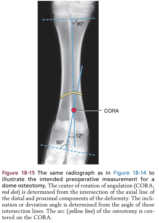 <ul><li><p><span>First the pivot point is identify and is referred to as the center of rotation of angulation (CORA)</span></p></li><li><p><span>Angle of the deformity is determined from the intersection of the drawn line</span></p></li><li><p><span>Dome or curve osteotomy is performed centered on the CORA</span></p></li><li><p><span>This allows two curved bone ends to angulate and translate on each other to correct the deformity with maximal bone contact and the limb length is maintained because no bone is removed</span></p></li></ul>