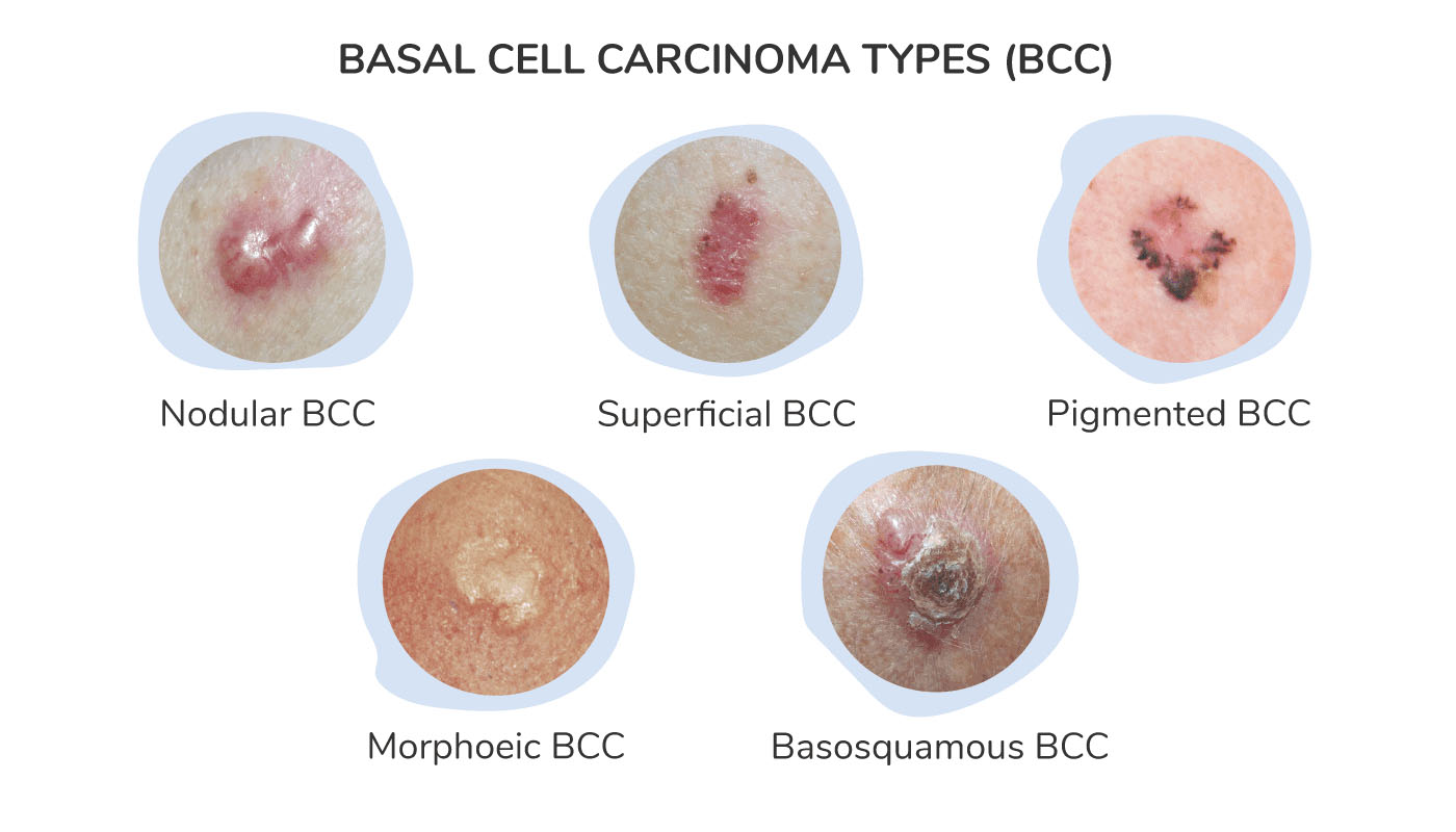 <p>PP: locally invasive<br>rarely metastasizes</p><p>RF: sun-exposed/damaged areas<br>elderly<br>males<br>fair skin<br>previous skin injury<br>thermal burn</p><p>CM: “lesion that won’t heal+keeps bleeding”</p><p><u>nodular</u> (most common)</p><p><u>superficial</u> (least aggressive)</p><p><u>sclerosing</u> (most aggressive)</p><p><u>pigmented</u> (confused with melanoma)</p><p>TX:<br>NP:<br>surgical excision<br>electrodessication+curettage (ED&amp;C)<br>moh’s surgery<br>radiation</p><p>MX:<br>imiquimod cream<br>PO vismodegib x lifelong</p>