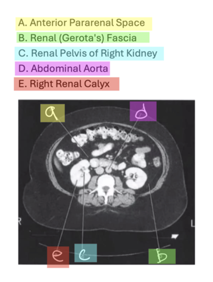 <p>A. Anterior Pararenal Space</p><p>B. Renal (Gerota's) Fascia</p><p>C. Renal Pelvis of Right Kidney</p><p>D. Abdominal Aorta</p><p>E. Right Renal Calyx</p>
