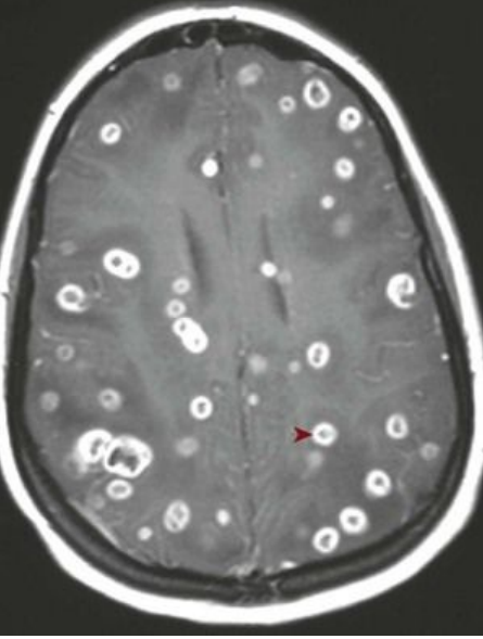 <p>8.6 Side A (PBD9: 367; BP9: 312)<br></p>
<p><br></p>
<p>Questions<br></p>
<p>A 41-year-old cardiac transplant recipient develops fever, cough, and headache. CSF shows long filamentous gram-positive organisms; MRI shows brain abscesses.<br></p>
<p><br></p>
<p>1. What infection does he have?<br></p>
<p>2. What immune defect is likely present?<br></p>
<p>3. Where did this infection start?<br></p>