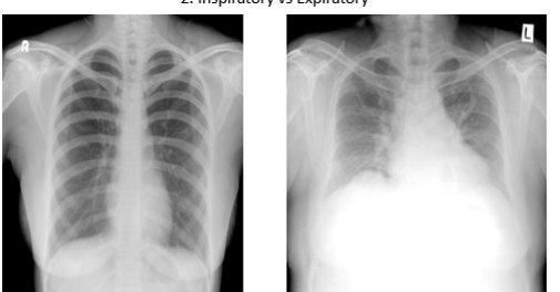 <p>which is inspiration vs expiration. how do u known</p>