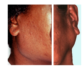 <p><span>Tumour Like Lesions of the Parotid Salivary Gland</span><br><br><span>Diffuse Swelling around the angle of the mandible but linked with Sjogren's Syndrome</span></p>