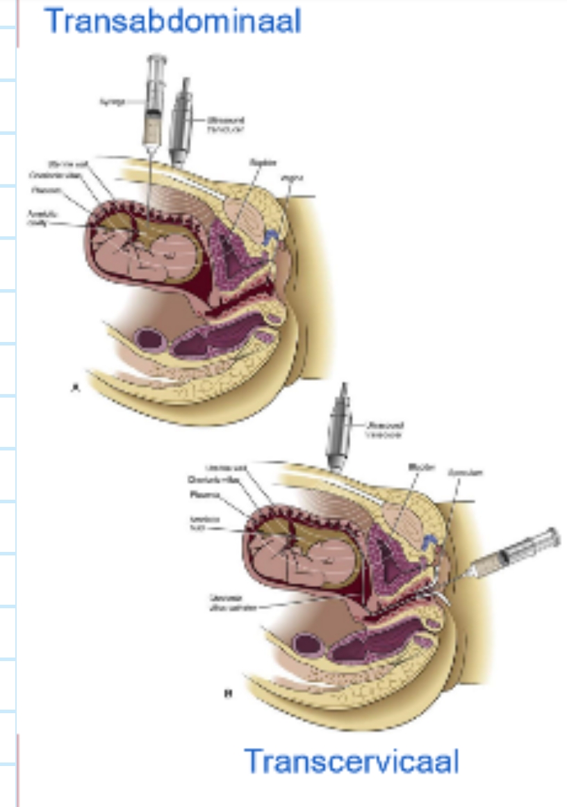 <p>Vlokkentest (CVS = Chorionic Villus Sampling)</p><ul><li><p>prenatale diagnostische procedure: om bepaalde genetische &amp; chromosomale afwijkingen bij de foetus op te sporen</p></li><li><p>staalname van chorionvlokken</p></li><li><p>cellen bevatten hetzelfde genetische materiaal als cellen van de foetus → waardevolle bron voor genetisch onderzoek</p><ul><li><p>genetisch, morfologisch, biochemisch onderzoek</p></li></ul></li><li><p>doorgaans uitgevoerd tussen 10e &amp; 12e week van de zwangerschap</p></li><li><p>op 2 manieren:</p><ul><li><p>via de cervix → transcervicaal</p></li><li><p>door de buikwand → transabdominaal</p></li></ul></li><li><p>belangrijkste voordeel van CVS tov andere prenatale tests (bv. amniocentese = vruchtwaterpunctie): kan eerder in zwangerschap uitgevoerd worden</p></li></ul><p>→ chorion &amp; trofoblast delen dezelfde genetische informatie omdat ze beide afkomstig zijn van dezelfde bevruchte eicel &amp; dus hetzelfde DNA delen</p><p></p>