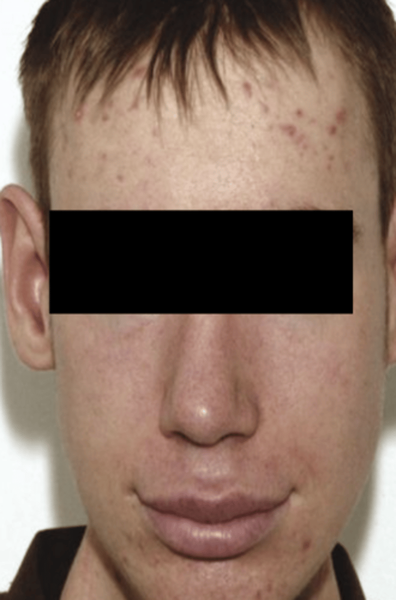 <p>Genetic mutation -- autosomal dominant</p><p>Mucosal neuromas on lip, tongue, BM, gingiva, &amp; palate (can be 1st sign of disease)</p><p>Pheochromocytomas</p><p>Marfanoid appearance</p>