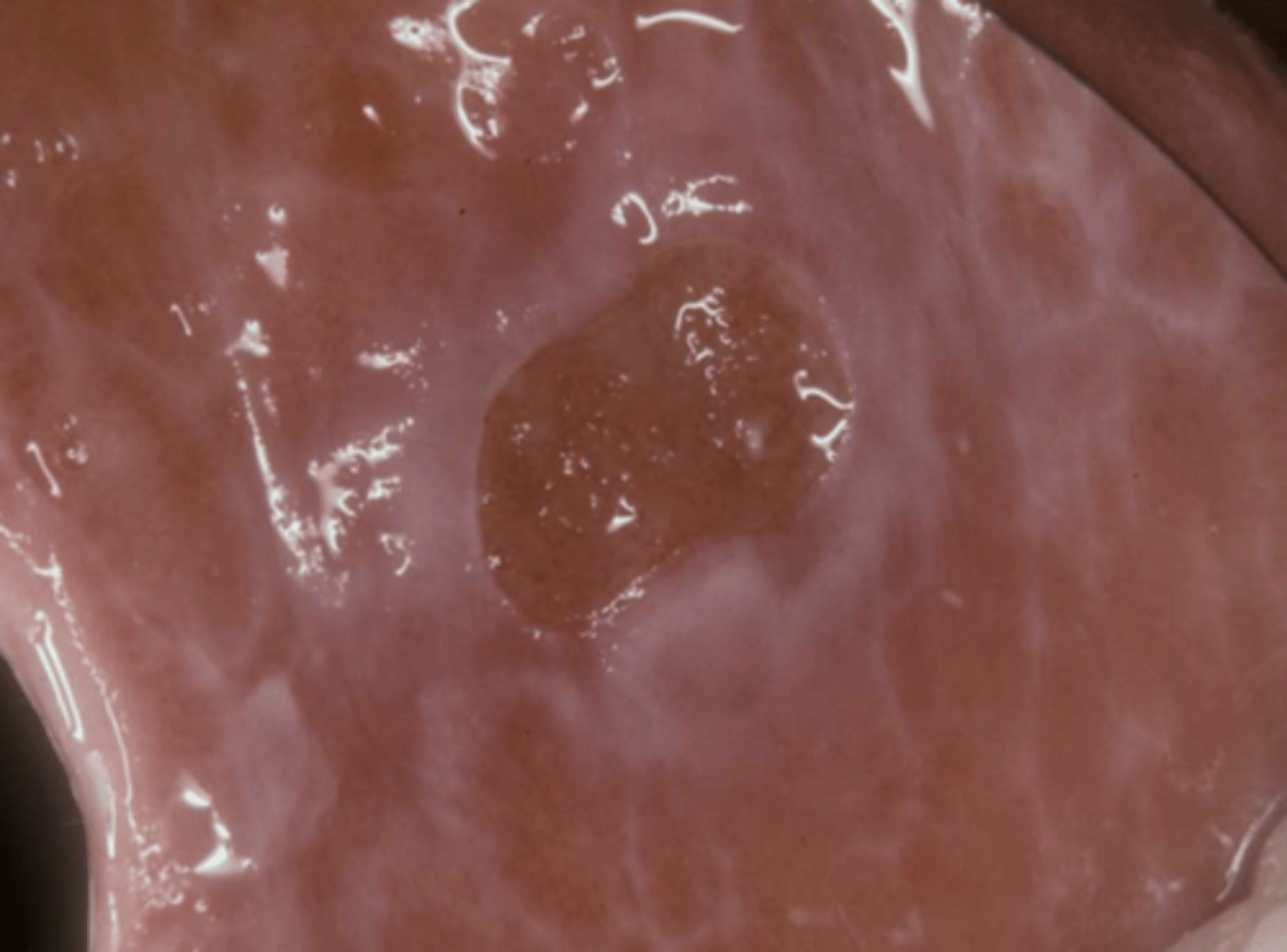 <p>Patient presents with an ulcer on the buccal mucosa and along with fever, butterfly malar rash and reports weight loss and fatigue. What condition?</p>