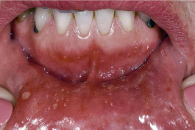 <p>what is the diagnosis of this lesion that occurs of MOVABLE mucosa </p>
