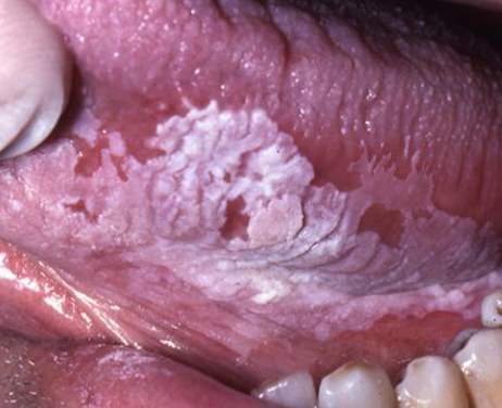 <p>PREMALIGNANT white lesion that cannot be wiped off </p>