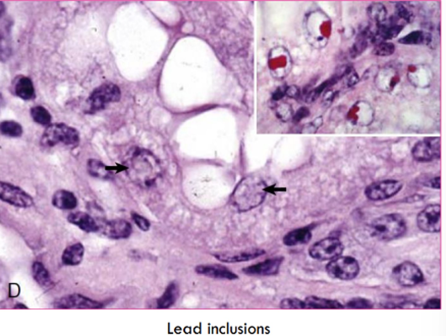 <p>intranuclear, renal tubular epithelial cells</p>