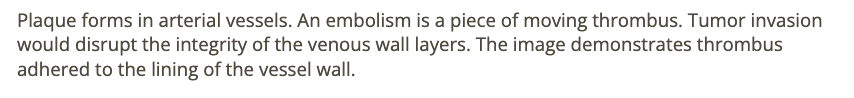 <p>d) thrombus formation </p>