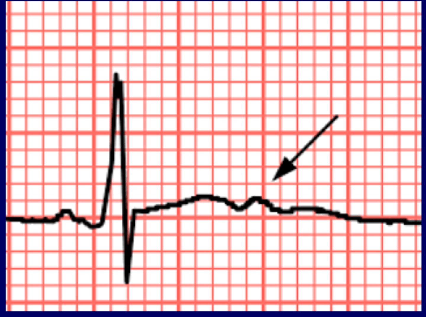 <p>prominent U wave</p>