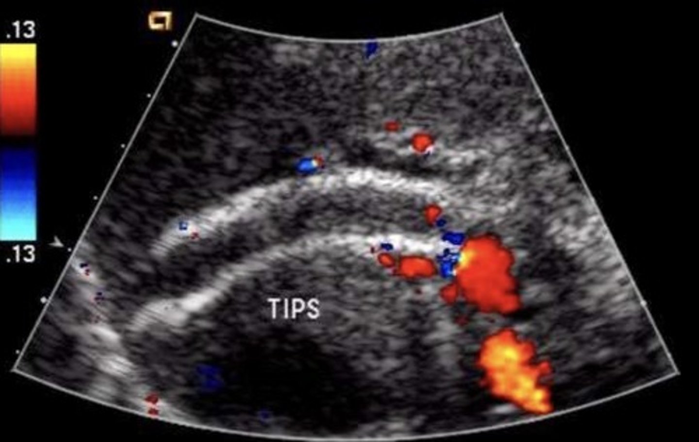 <p>Hepatopetal flow in right &amp; left portal veins</p><p>Hepatofugal flow in main portal vein</p>