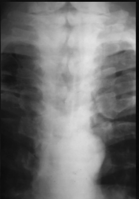 <p>what is seen here for this case of cleidocranial dysplasia?</p>