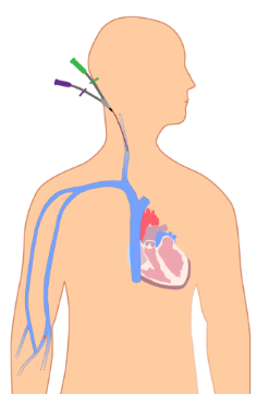 <p>what is the insertion point shown for this non-tunneled CVC</p>