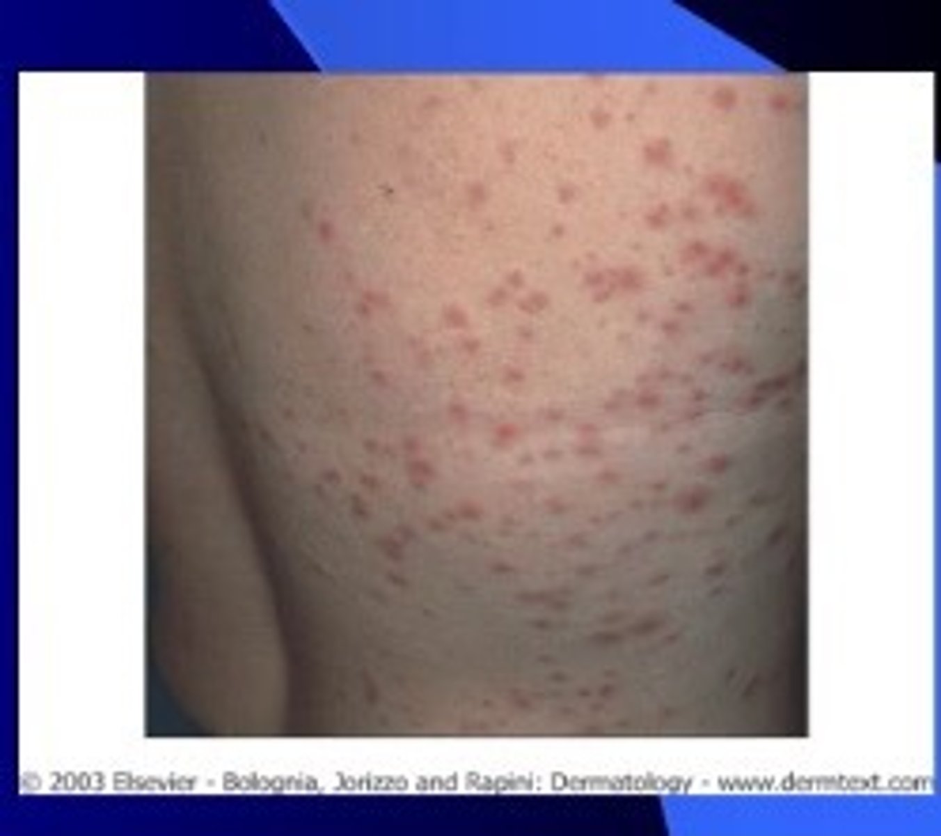<p>Hot tub folliculitis</p><p>Self-limiting</p>