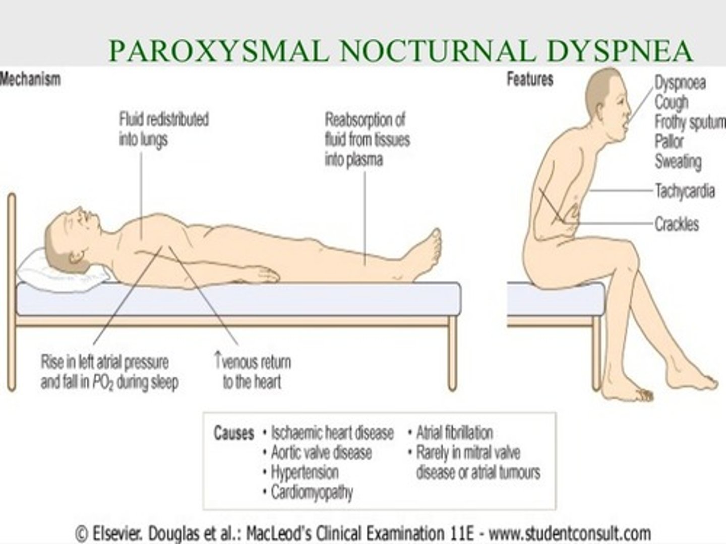 <p>Severe shortness of breath, especially at night after several hours of reclining; the person is forced to sit up to breathe.</p><p>-trouble breathing at night</p>