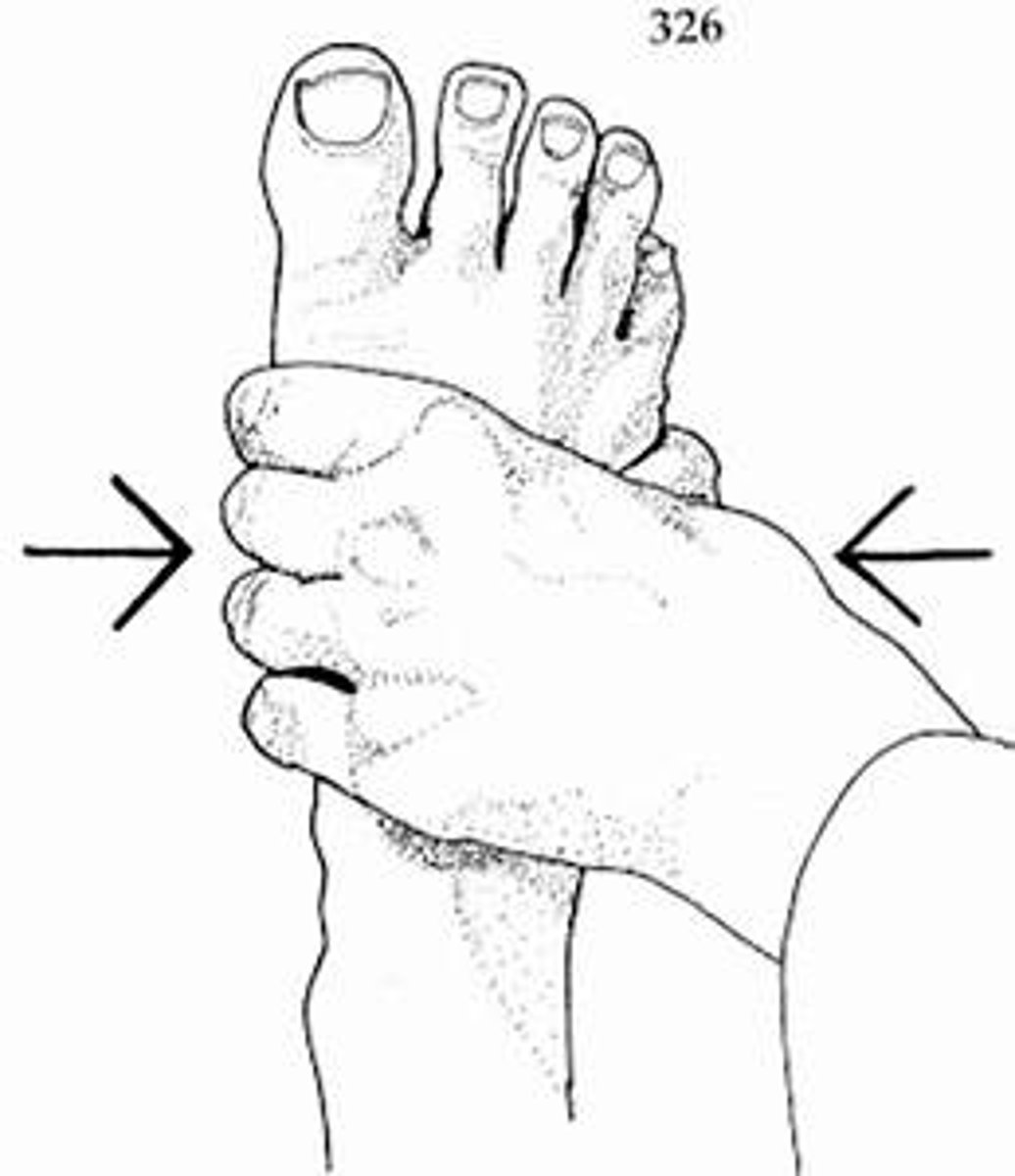 <p>pain between the 3rd and 4th metatarsal head</p><p>- where the examiner grabs the metatarsal head + squeezes the heads together</p>