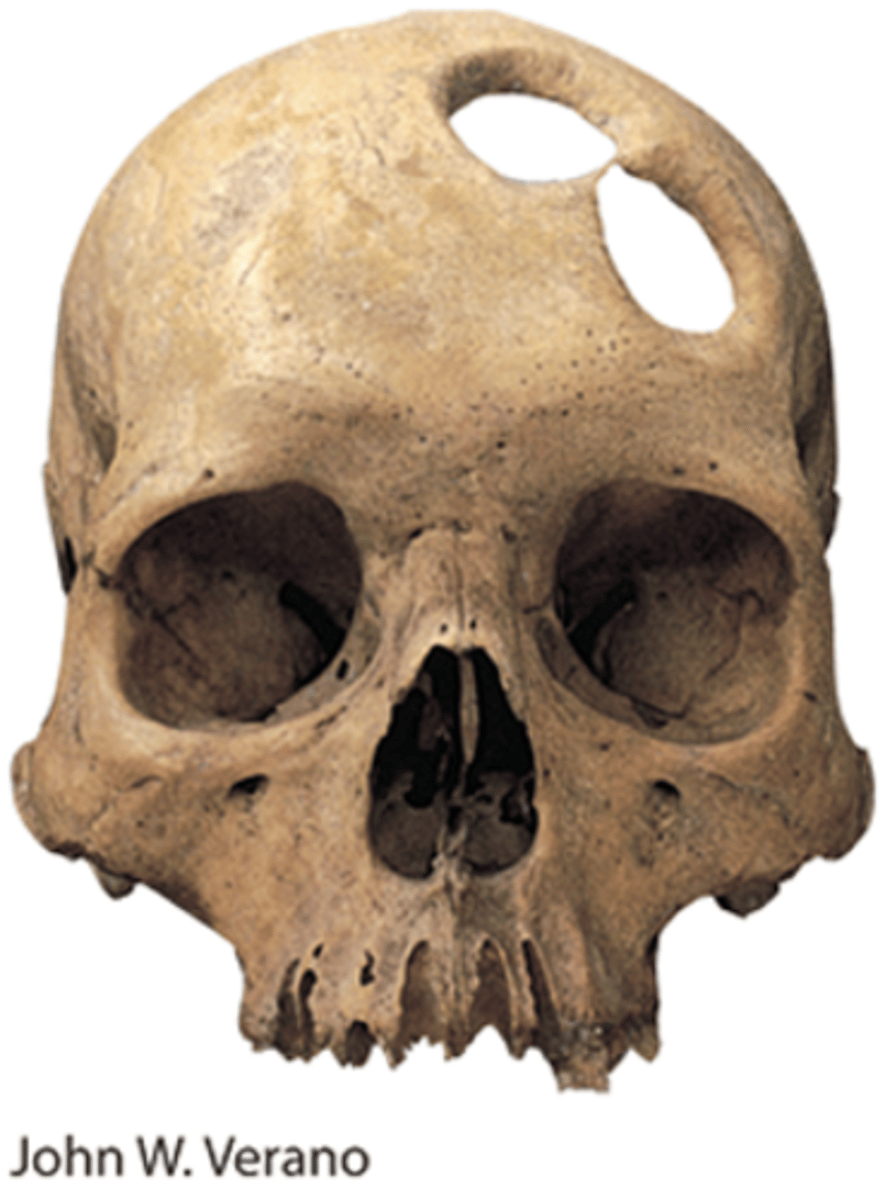 <p>-Through the ages, psychologically disordered</p><p>people have received brutal treatments, including the trephination evident in this Stone Age skull.</p><p>-Drilling skull holes like these may have been an</p><p>attempt to release evil spirits and cure those with</p><p>mental disorders</p>