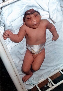 <p>Anencephaly </p>