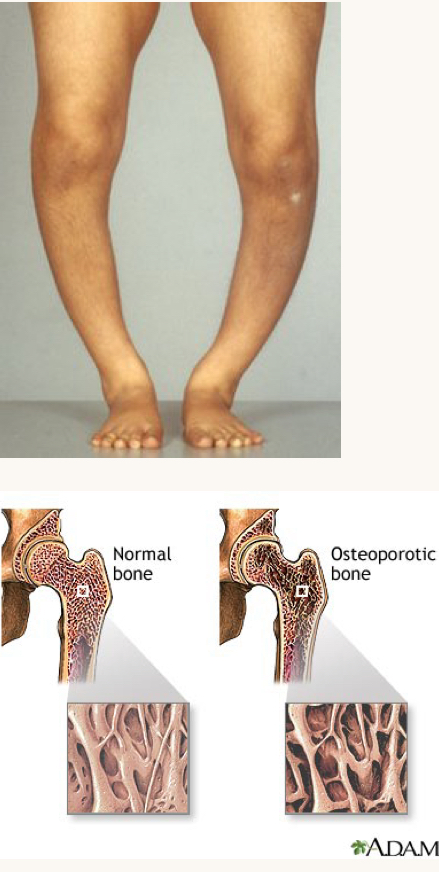 <p>what is this condition and what vitamins is this person likely deficient in?</p>