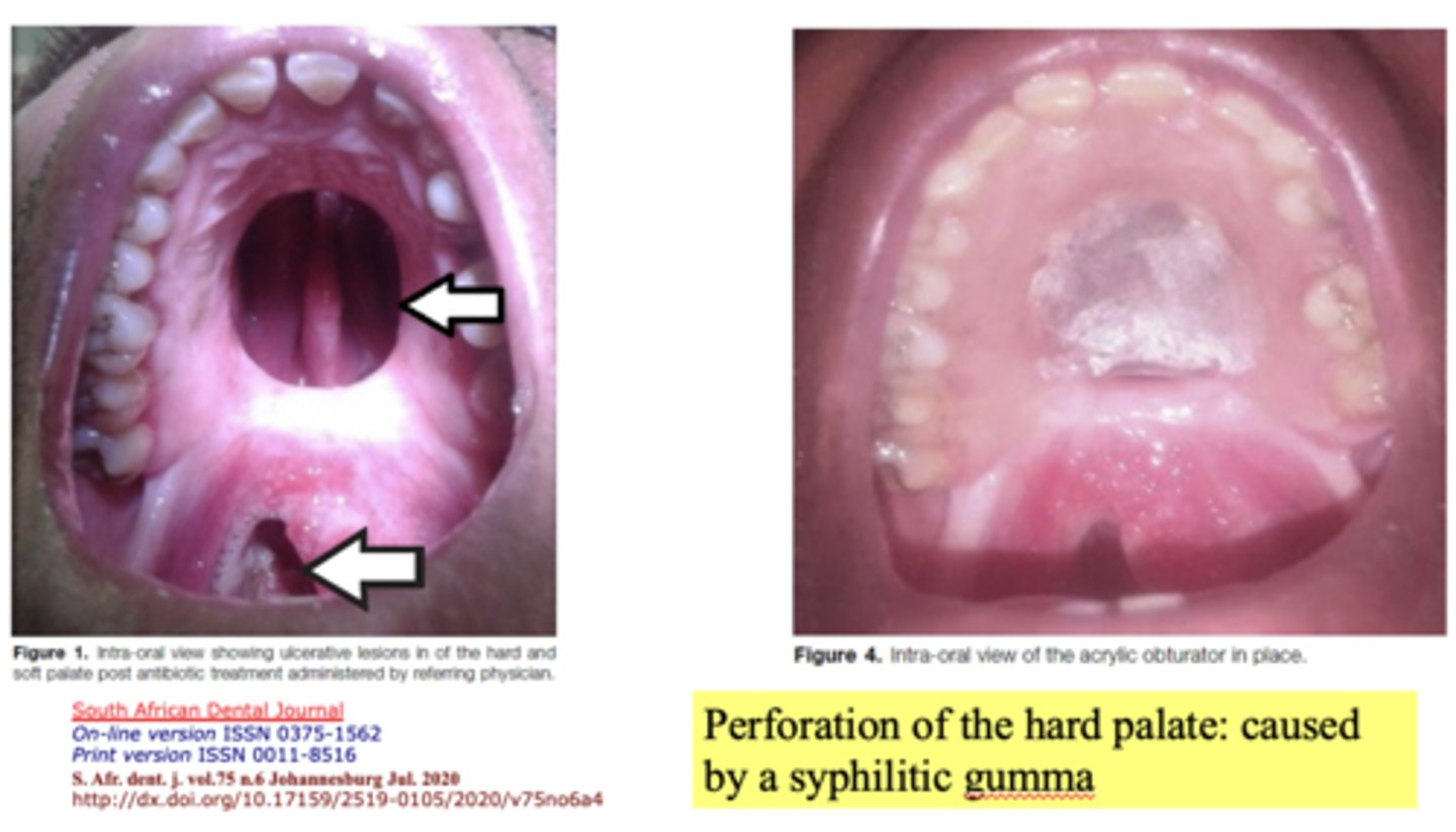 <p>Syphilitic gumma</p>
