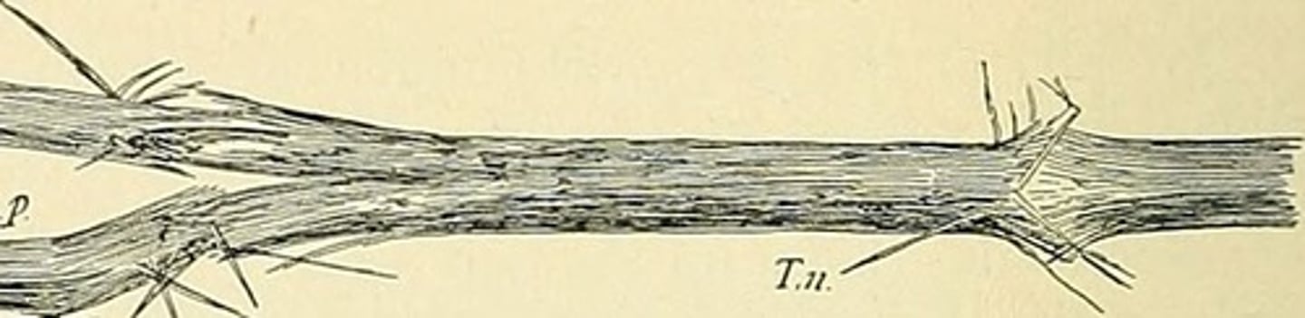 <p>technical term for knotted hair; it is characterized by brittleness and the formation of nodular swellings along the hair shaft.</p>