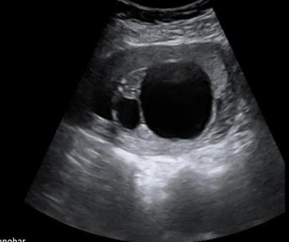 <p>a) duodenal atresia</p><p>b) esophageal atresia</p><p>c) posterior urethral valves</p><p>d) UPJ obstruction</p>