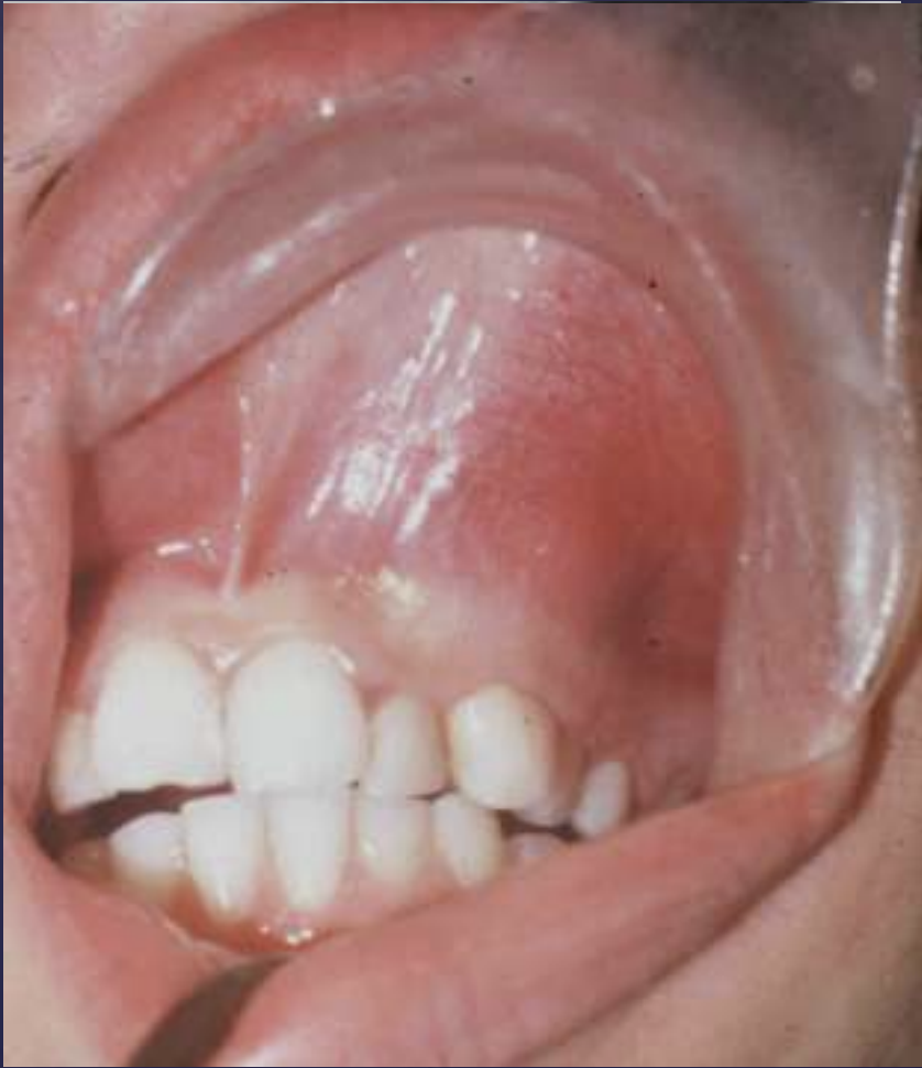 <p>Age: 70% 10-20 years</p><p>Location: 70% maxilla, 90% anterior</p><p>Sex: female>male</p>