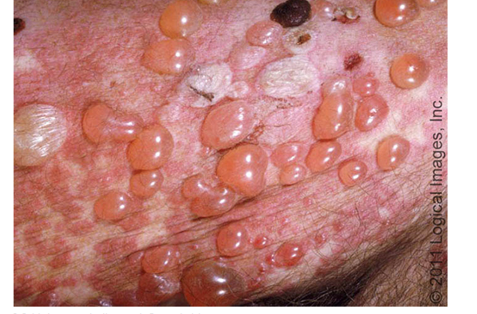 <p>autoimmune chronic inflammatory sub epidermal blistering dz</p><p>cause: hypothesized destruction and inflammation caused by IG binding in epithelial basement membrane zone</p>