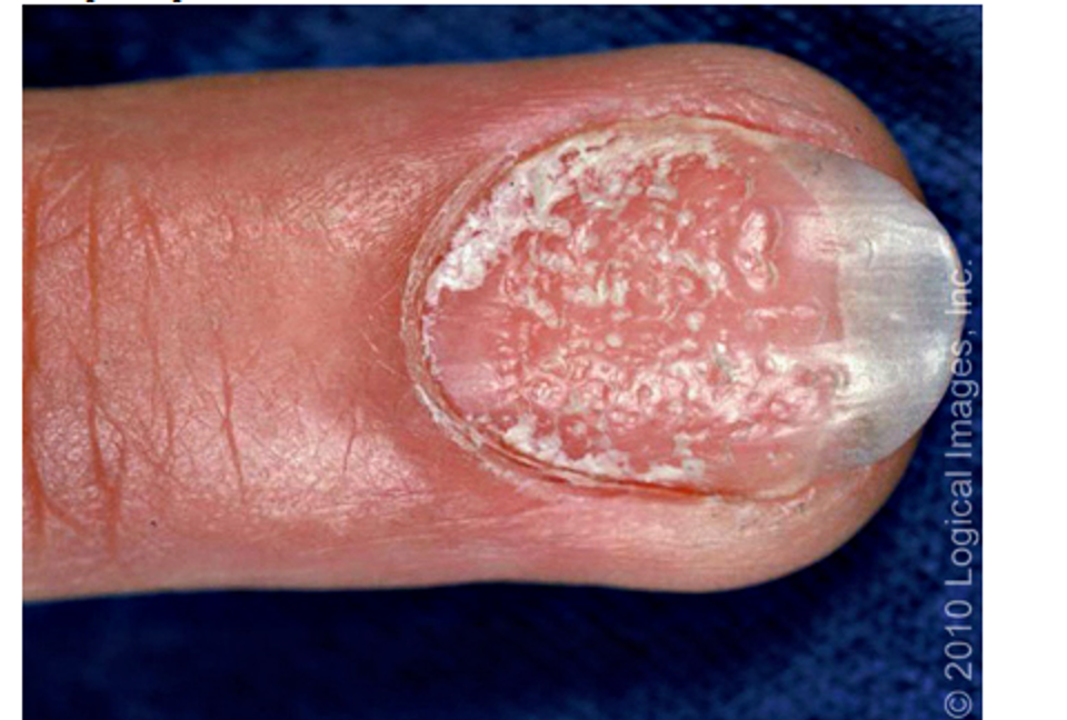 <p>what condition?</p><ul><li><p><strong>pitting </strong>leukonychia, nail dystrophy, red spots on lunula and crumbling of nail plate; splinter hemorrhages</p></li><li><p><strong>subungual hyperkeratosis</strong></p></li><li><p><strong>oil drop sign- </strong>changes in nailed to tan/brown</p></li><li><p>common w/ psoriatic arthritis</p></li></ul><p></p>