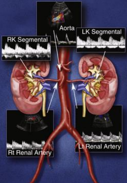 <p>Renal arteries have ___ resistance waveforms</p>