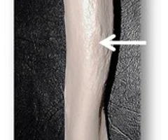 roughened surface on lateral side of shaft 