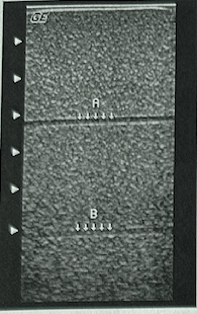 <p>In this phantom image, two fluid-filled tubes are present. What type of resolution is being evaluated?</p><p>a. Axial</p><p>b. Lateral</p><p>c. Contrast</p><p>d. Elevational</p><p>e. Temporal</p>