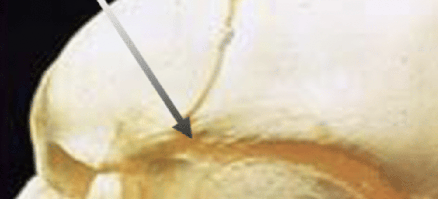 <p>anterolateral fontanel</p>