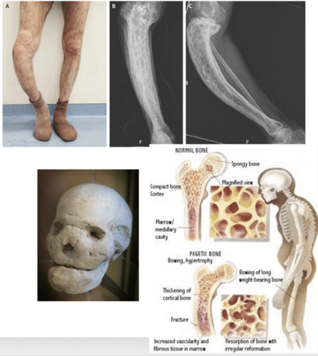 <p>What is the treatment for Paget's disease (osteitis deformans)?</p>