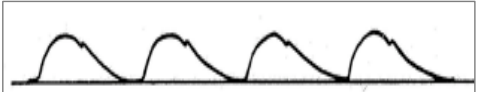 <p>Pressure of the pulse: diminished</p><p>Contour: upstroke slow, peak prolong</p><p>Causes: decreased stroke volume (heart failure), hypovolemia, aortic stenosis, an increased peripheral resistance (cold exposure and congestive heart failure can cause this)</p>