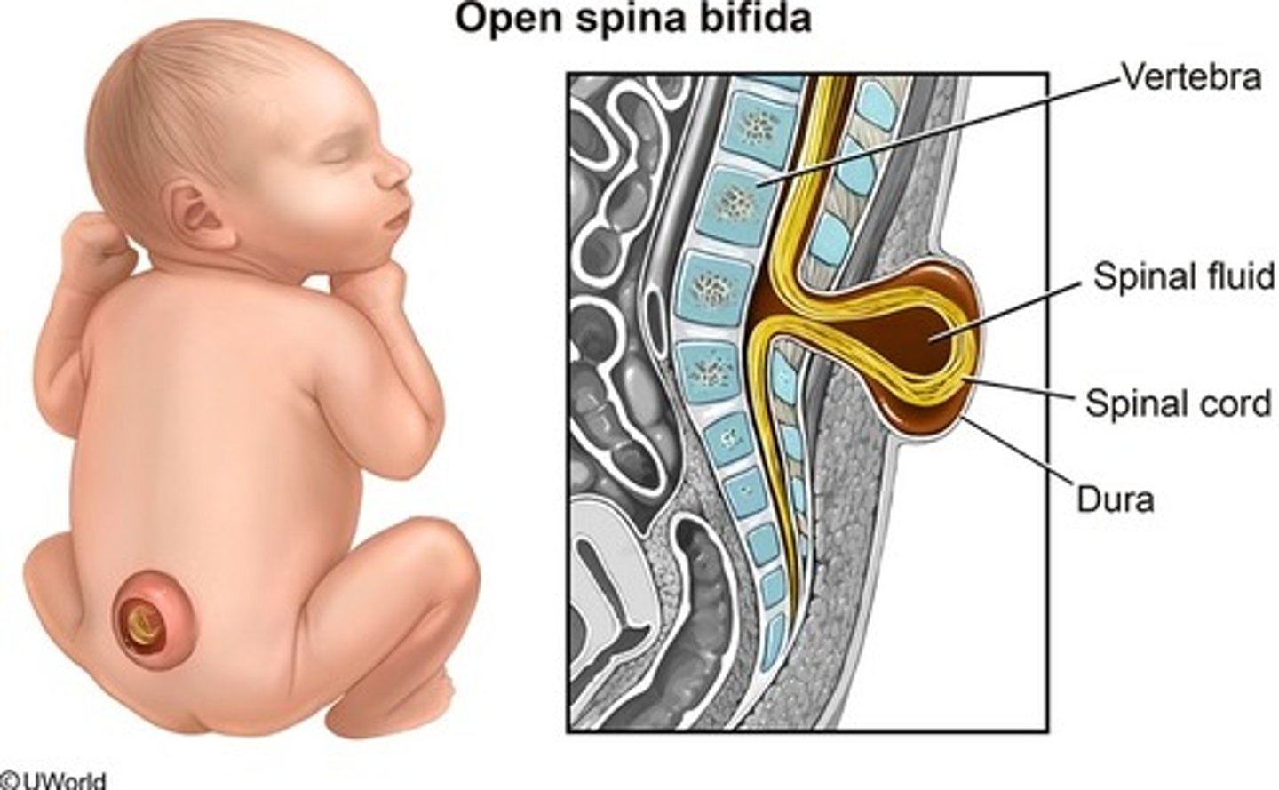 <p>most severe form of spina bifida in which the spinal cord and meninges protrude through the spine</p>