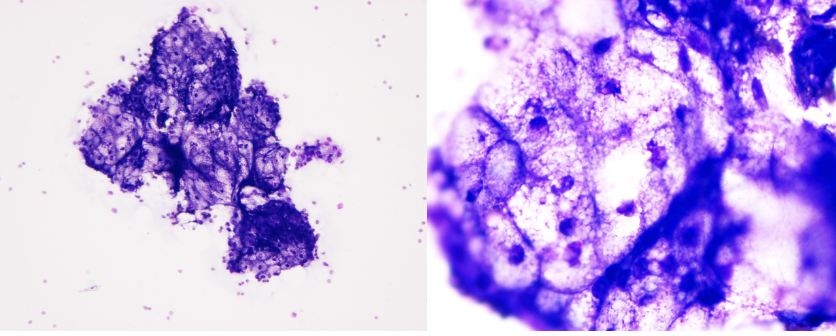 <p>What is your cytologic diagnosis?</p><p>A. Epidermal inclusion cyst </p><p>B. Lipoma </p><p>C. Sebaceous adenoma </p><p>D. Mast cell tumor </p>